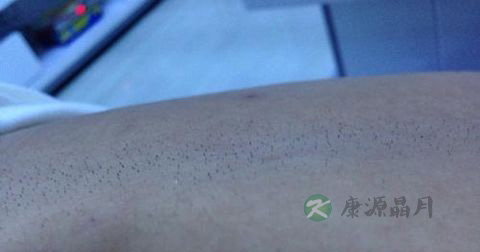 毛囊炎用皮炎平可以吗