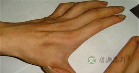 肌肉萎缩怎么治
