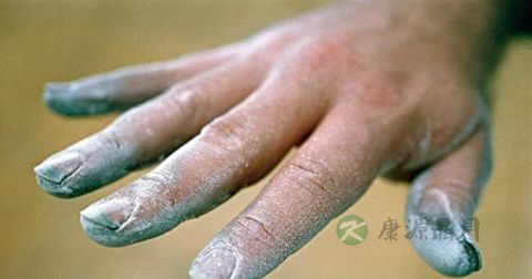 治灰指甲的药有哪些