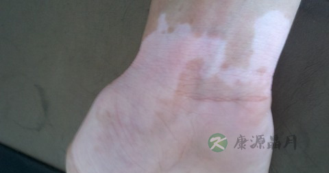 白颠疯是传染病吗