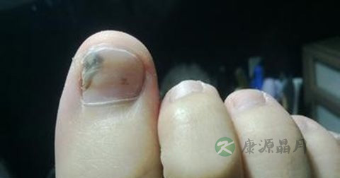 治疗灰指甲的偏方