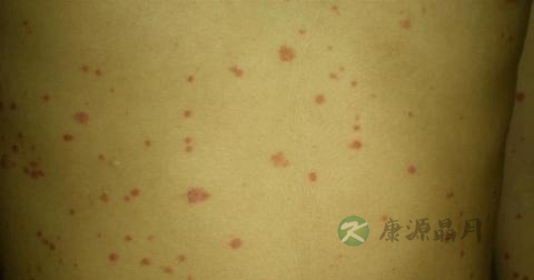 怎样治疗牛皮癣