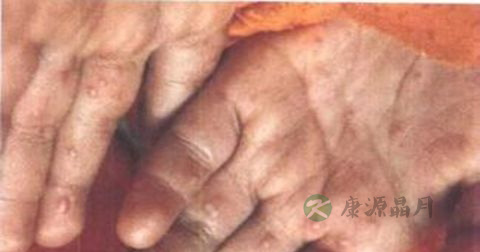 手足口病吃什么药