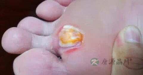 脚上有鸡眼怎么办