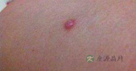 疖子化脓了怎么办