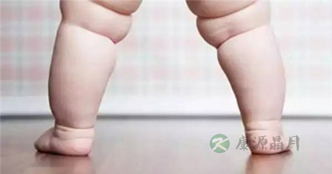 先天性髋关节脱位能治好吗