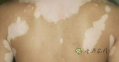 白驳风在能治好吗