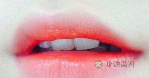 唇炎怎么治疗