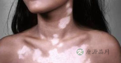 治疗白殿风的方法