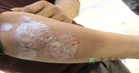 牛皮癣治疗偏方