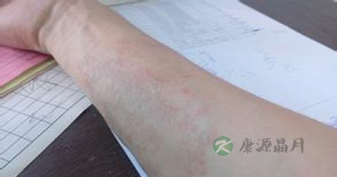 皮炎的治疗