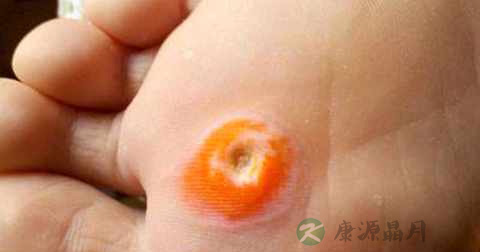 长肉刺怎么治