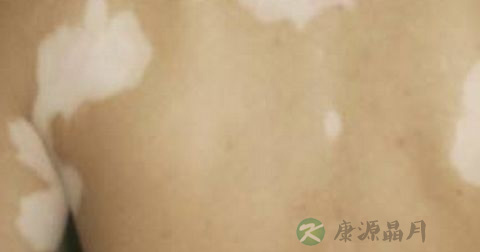 白癜风传播途径