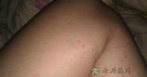 传染性红斑的病因