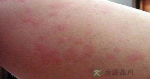 寻马疹是传染病吗