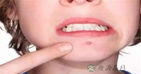 毛囊炎是青春痘吗