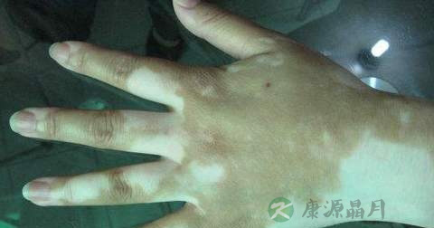 白驳风在能治好吗