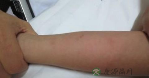 海绵体血管瘤最佳治疗方法