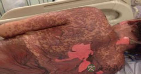药物过敏的急救措施