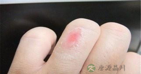 烫伤第一自救方法