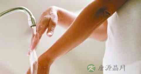 烫伤后擦什么缓解疼痛