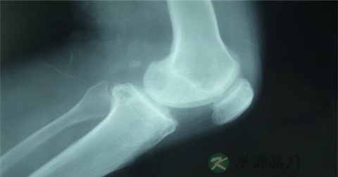 胳膊摔断了怎么急救