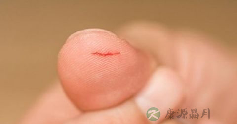 婴儿皮肤出血紧急护理