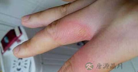 烧伤烫伤急救处理