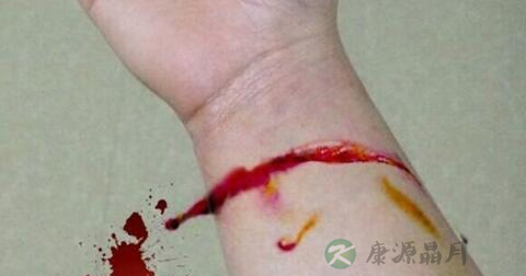 割腕怎么急救