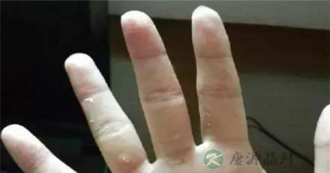 热水烧伤怎么紧急处理