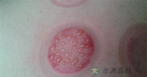 拔罐起水泡怎么回事 怎么办好