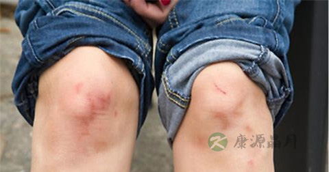 静脉血栓的护理措施