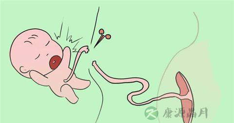新生儿脐带怎么护理