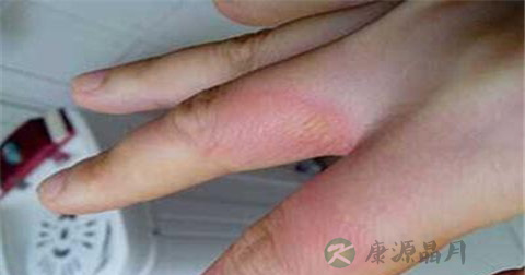 烧伤的急救措施
