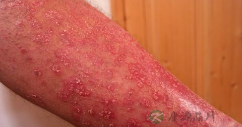 氰化物中毒急救措施
