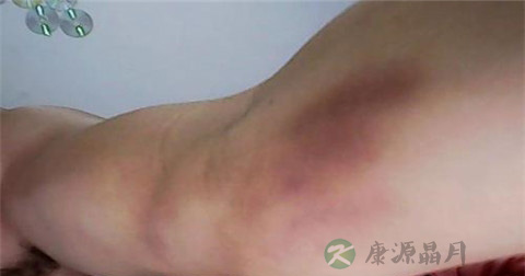小孩摔倒青了如何去青