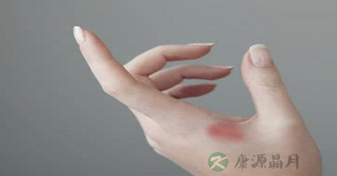 烫伤愈合多久开始增生