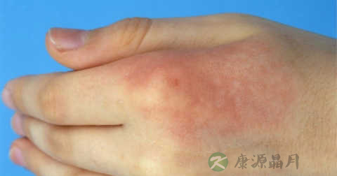 开水烫伤怎样处理方法