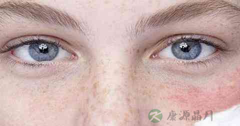 脸过敏急救的方法