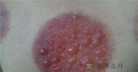 烫伤起水泡怎么处理