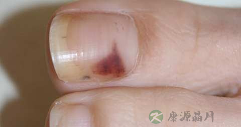 指甲裂伤出血该怎么办