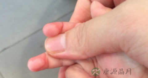被热水烫伤怎么办