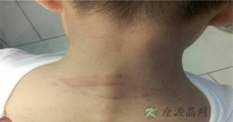 小孩摔倒青了如何去青