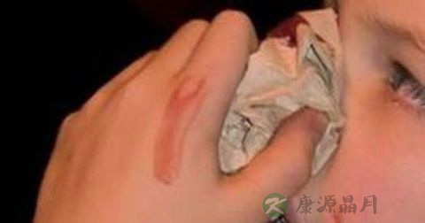 流鼻血的正确处理措施