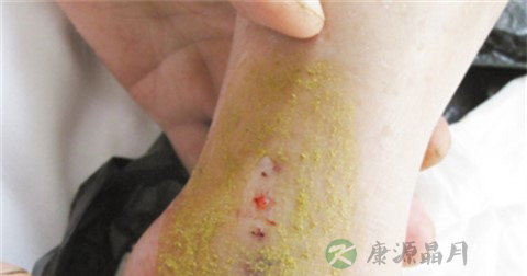 毒蛇咬伤后的急救措施