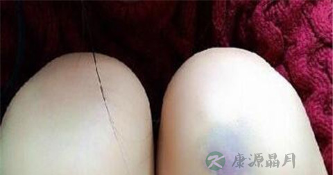 小孩摔倒青了如何去青