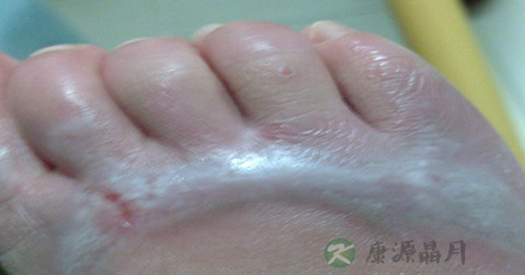 烫伤愈合多久开始增生