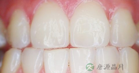二氧化锆全瓷牙价格