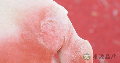 糖尿病患者早期饮食如何安排