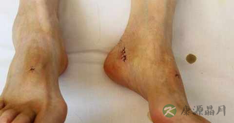 糖尿病周围神经病的临床表现